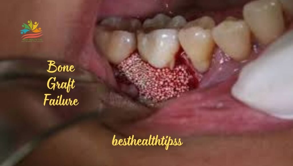 Bone graft failure 