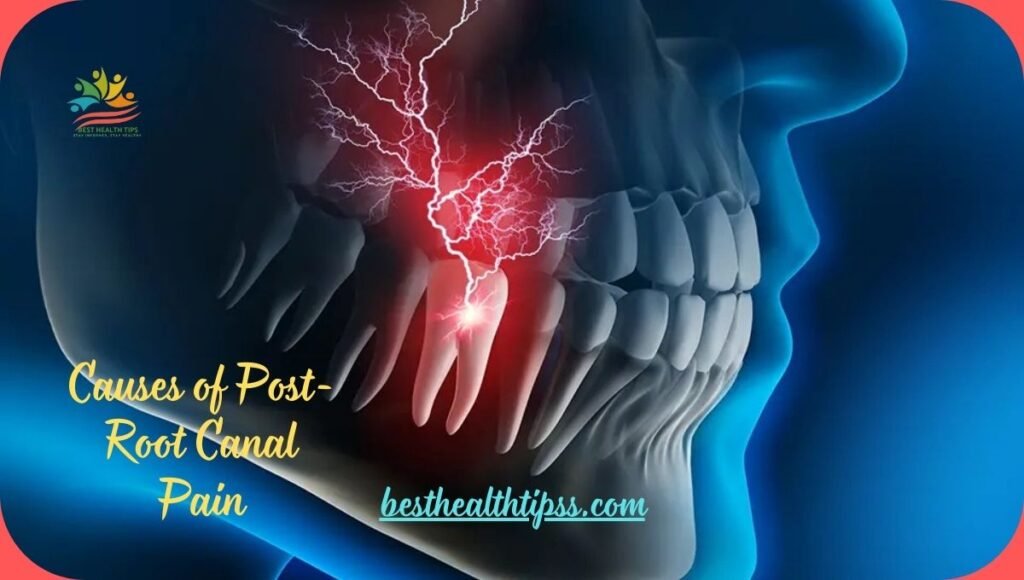 causes of root canal pain