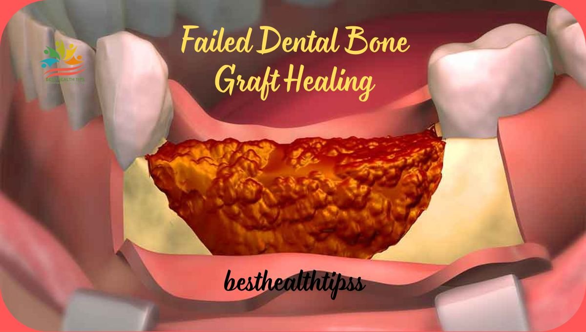 Failed Dental Bone Graft Healing