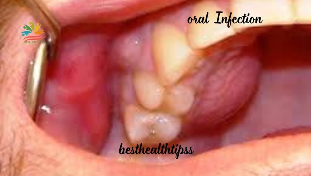 Infection can delay oral healing.