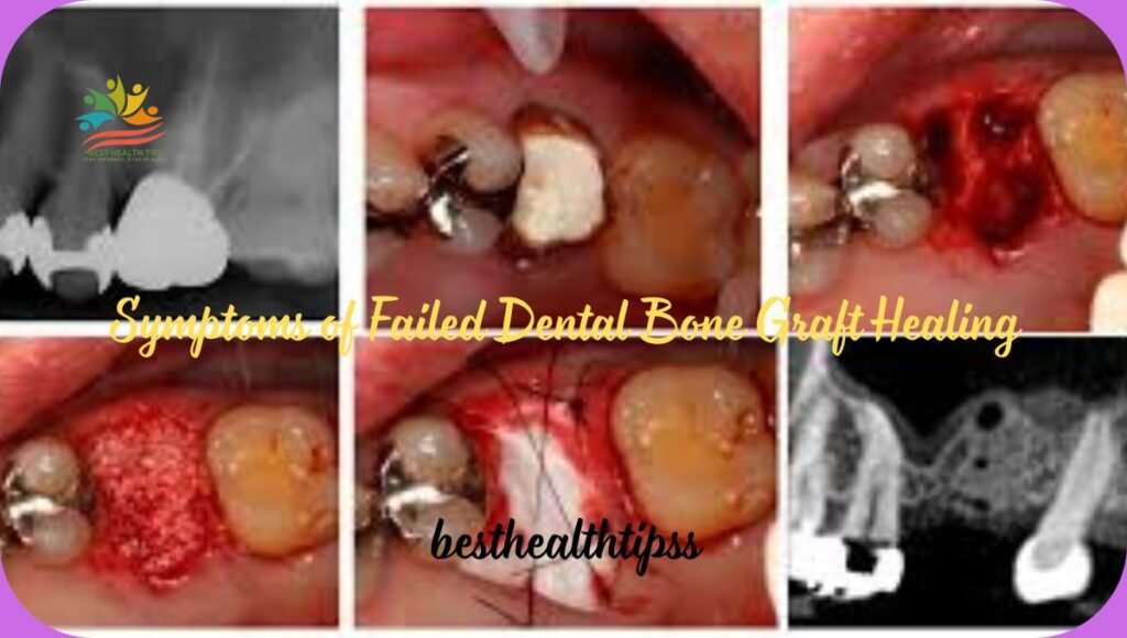 Symptoms of Failed Dental Bone Graft Healing