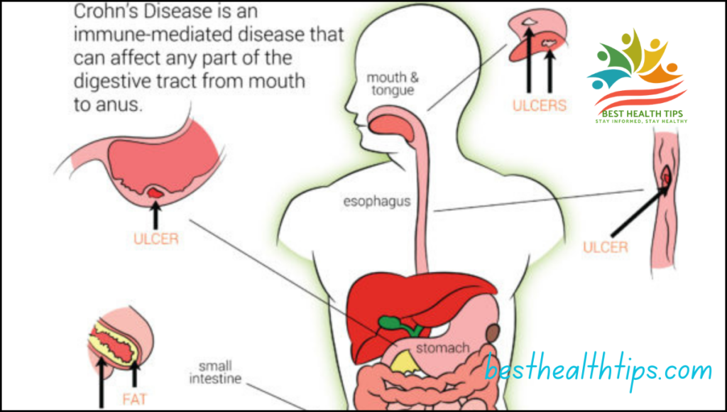 Can you Cacciatore With Crohn’s Disease