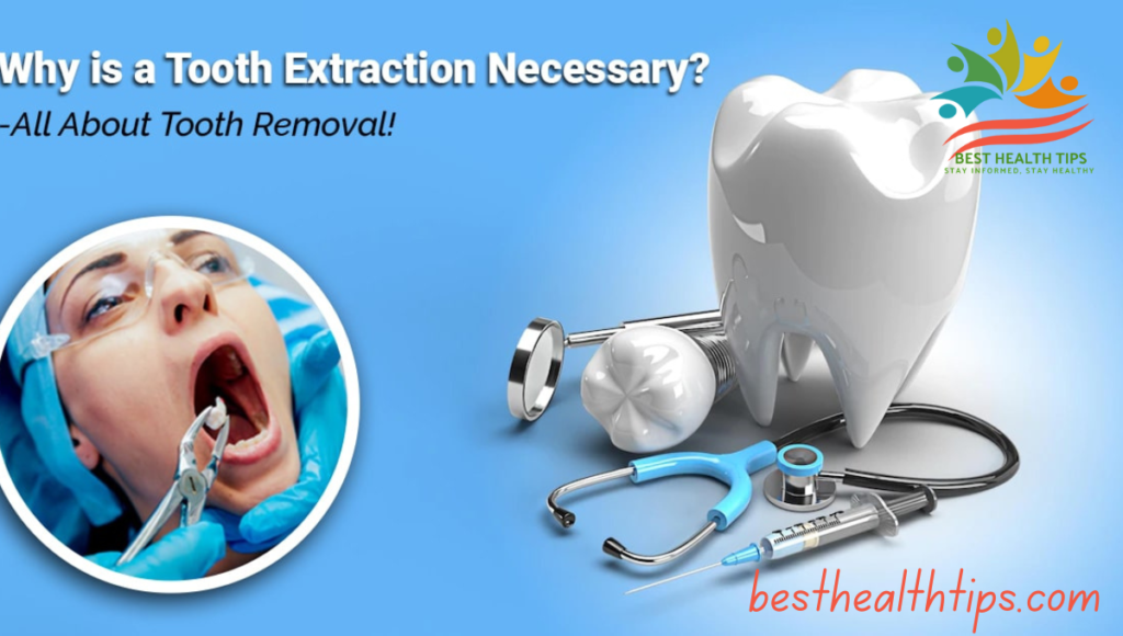 Benefits of Tooth Extraction