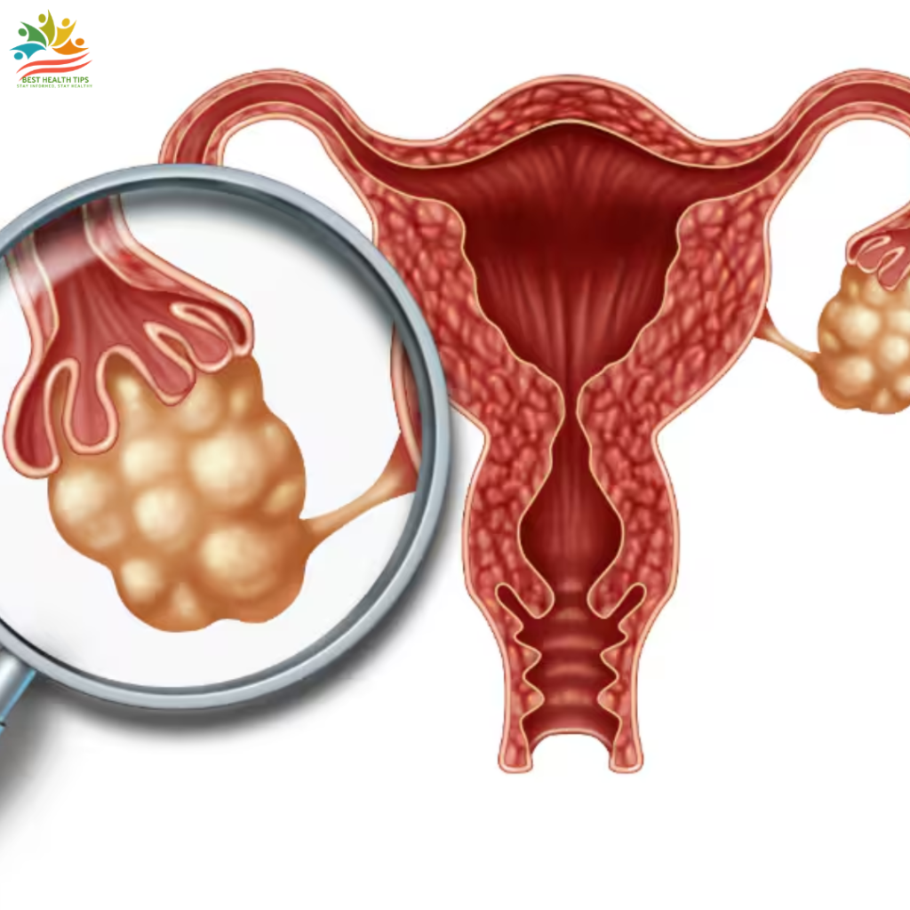 pcos recommended protein