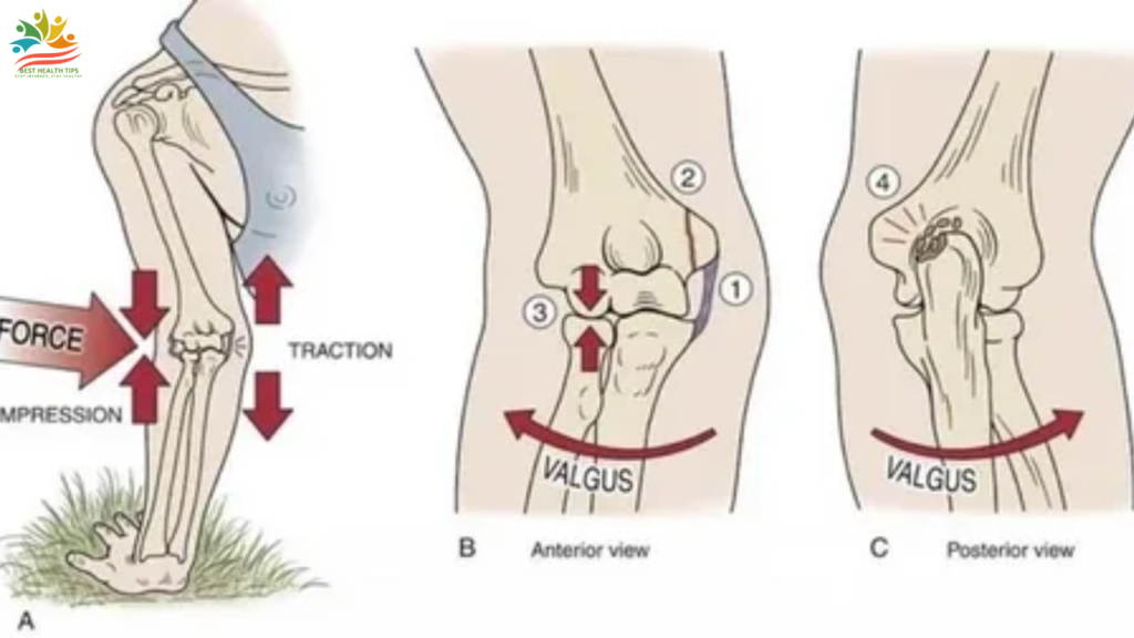 valgus extension overload exercise