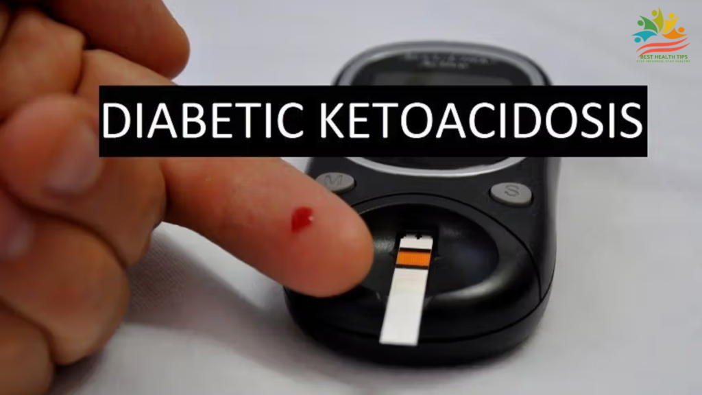 Diabetic Ketoacidosis Nemours