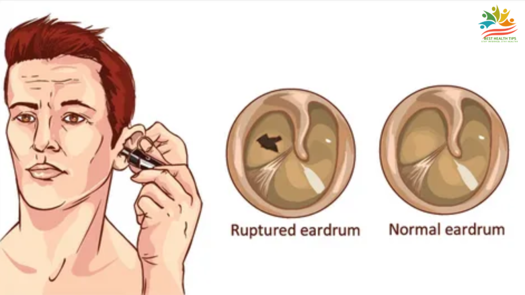 What Side Should I Sleep On With A Ruptured Eardrum