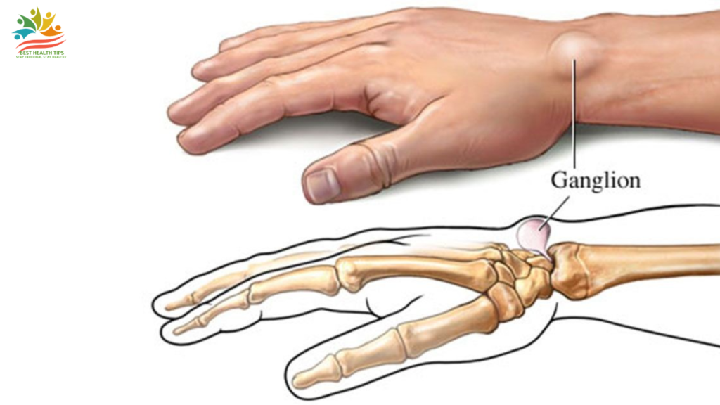 Ganglion Cyst Vitamin Deficiency